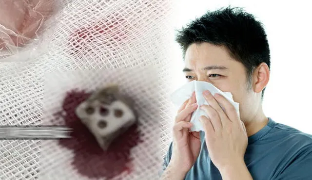 Aunque el joven busco tratar su afección con medicina tradicional china, fue una endoscopia que reveló y permitió sacar el dado. Foto: composición LR/iStock/Weibo