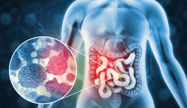 Estudio científico revela el alarmante aumento del cáncer de colon en menores de 50 años. Foto: Rocky Mountain Cancer Centers