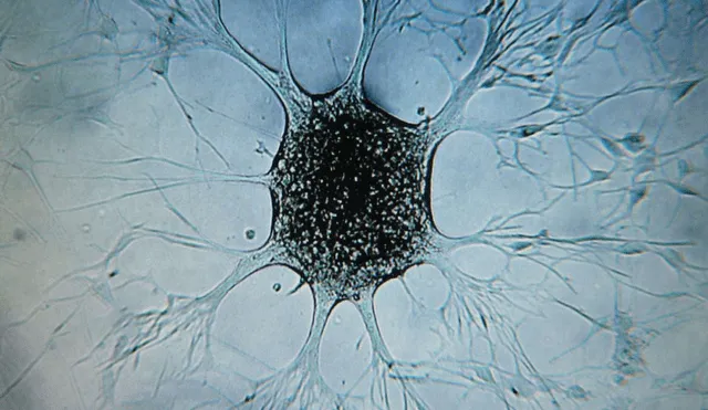 La proteína p62 podría utilizarse como marcador pronóstico en tumores con alta inestabilidad cromosómica, ayudando a identificar tipos de cáncer más agresivos. Foto: ANSA