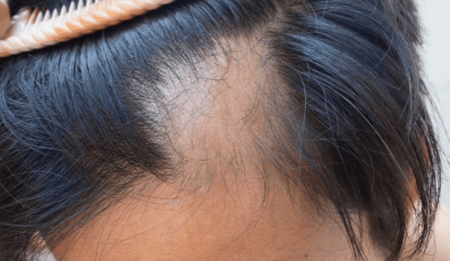 La alopecia es una condición médica que se caracteriza por la pérdida parcial o total del cabello. Foto: Smartclinic