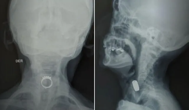 Mujer de 85 años comió un anillo mientras dormía: soñó que era caramelo y terminó internada en hospital de Lima. Foto: composición LR/RPP. Mujer de 85 años comió un anillo mientras dormía: soñó que era caramelo y terminó internada en hospital de Lima. Foto: composición LR/RPP.