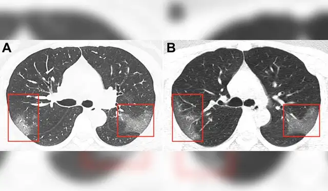 Evolución de las manchas en los pulmones después de tres días. Imagen: First Hospital of Lanzhou University.
