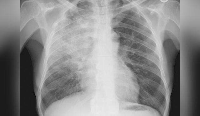 Los pulmones son unas de las zonas más afectadas por la fibrosis quística. Foto: Difusión.