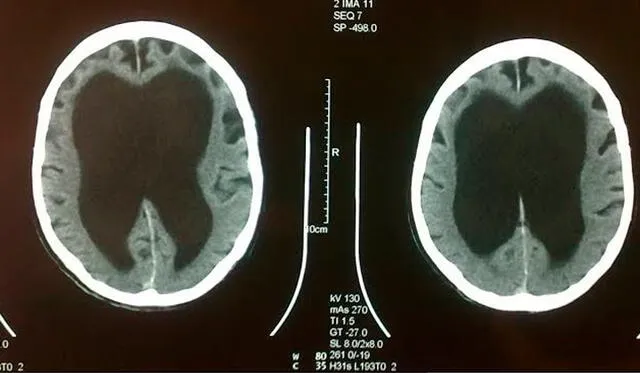 Hidrocefalia en humanos. Foto: Difusión.