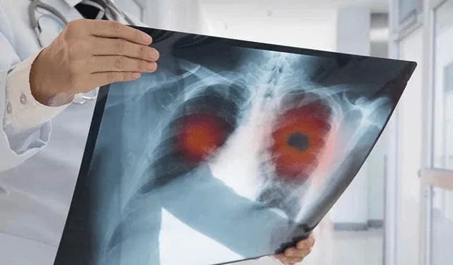 Más del 60% de casos de cáncer de pulmón son diagnosticados en estados avanzados. Foto: BBC   