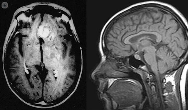 Una resonancia magnética que muestra un tumor cerebral. Foto: referencial / Clarín