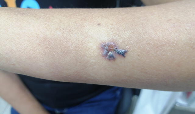  Una paciente muestra un tipo de lunar cancerígeno detectado en el brazo. Foto: Juana Gallegos/La República   