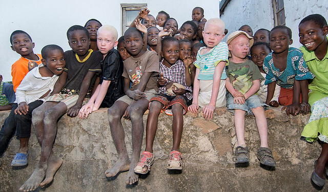 <br> La ONU advirtió que los albinos de Malawi están en riesgo de “extinción total”. Foto: Amnistía Internacional    