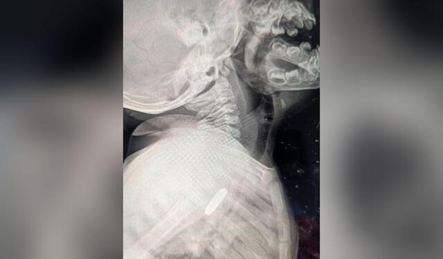  En la radiografía del niño demostró que una pila permanecía atascada en su esófago. Foto: Clarín    