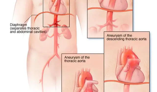 El aneurisma aórtico se manifiesta como un bulto en la aorta. Foto: Mayo Foundation   