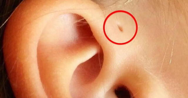 En cuál de las dos orejas aparece el orificio preauricular. Foto: Salud180  