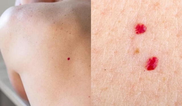 Los lunares de sangre suelen tener mucha presencia en áreas como la espalda o el pecho. Foto: composición LR/Semana/difusión   