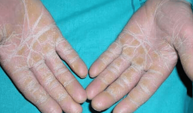   Hands can peel from contact with certain chemicals, according to specialists.  Photo: VHL   