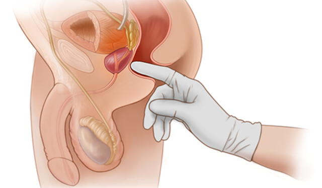  Es recomendable realizarse un examen de tacto rectal durante un chequeo preventivo de cáncer de próstata. Foto: Healthwise<br><br>    