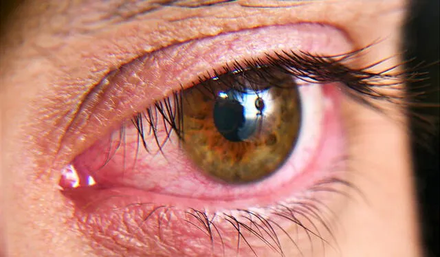  Ojo seco, una enfermedad en la vista que se puede evitar. Foto: Difusión.   