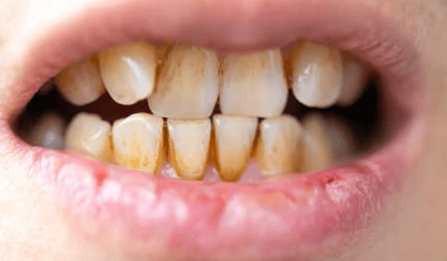  Los dientes sucios pueden desencadenar problemas cardiovasculares y cerebrales. Foto: difusión   