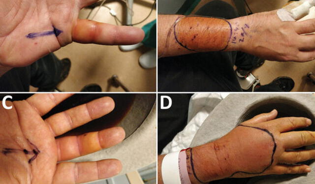  La mano y el antebrazo infectados del hombre del Reino Unido. A) muestra su dedo meñique izquierdo, B) su antebrazo derecho, C) su dedo medio derecho y D) su mano derecha. Foto: Jones et al.   