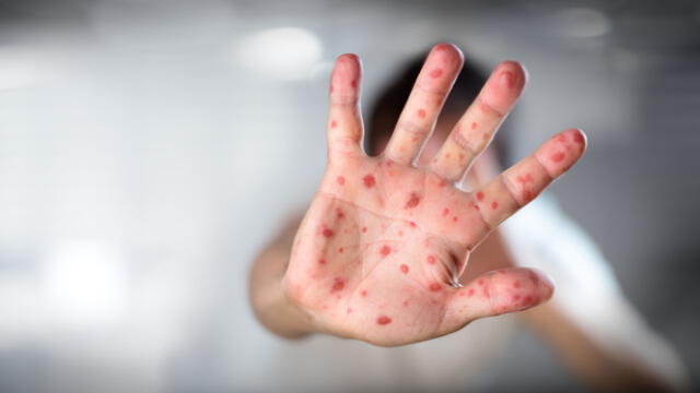  El sarampión se caracteriza por sarpullido en la piel, también llamado exantema. Foto: Getty   