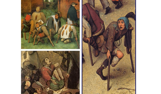  El ergotismo, que puede manifestarse de dos formas: gangrenoso o convulsivo. Foto: Los mendigos (Pieter Bruegel el Viejo, Museo del Louvre, París)    