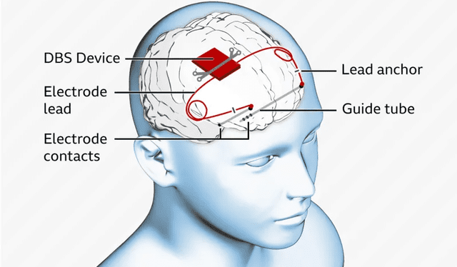  El aparato se instala en el cráneo y estimula ciertas áreas del cerebro. Foto: Getty/BBC    