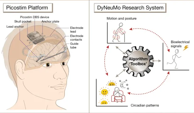  El proyecto PicostimTM-DyNeuMo incorpora instrumentación científica en el pequeño marcapasos cerebral cranealizado PcostimTM para explorar el papel de los ritmos circadianos, el movimiento y las señales cerebrales. Foto: Universidad de Oxford   