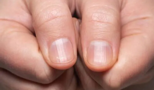  Las rayas de las uñas pueden manifestarse por diferentes causas como la ausencia de vitaminas y nutrientes. Foto: Silicium   