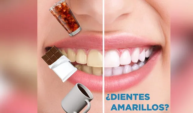 El consumo de gaseosa provoca que los dientes tomen un color amarillento. Foto: Super White    