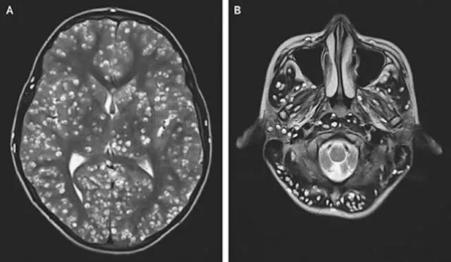  En 2019, un joven de 18 años fue hospitalizado tras consumir carne de cerdo cruda, lo que le provocó convulsiones y una infección de gusanos en el cerebro que terminó siendo fatal. Foto: TN.    