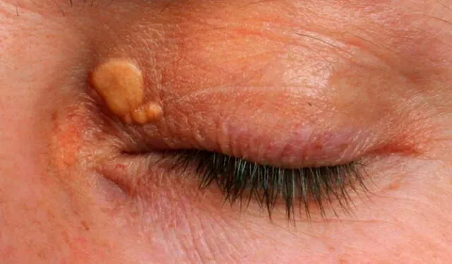  La Biblioteca de Medicina de Estados Unidos, explica que los xantomas aparecen cuando ciertas grasas se acumulan debajo de la piel. Foto: Today   