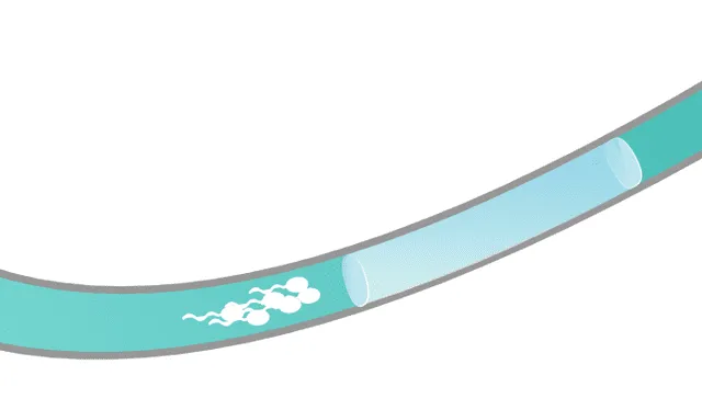 El implante bloquea el paso de los espermatozoides hacia el semen. Foto: Contraline