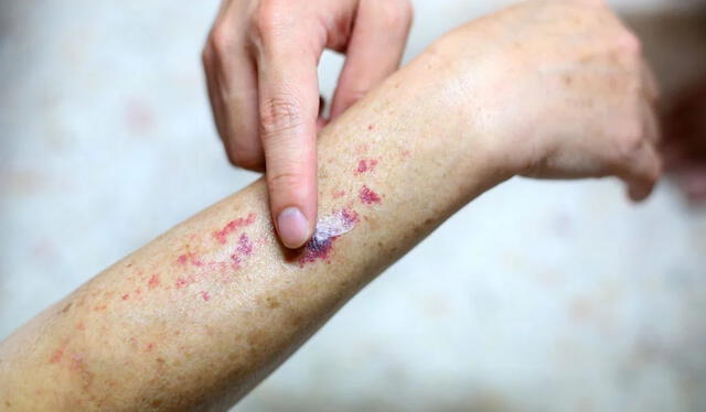 La leucemia es un cáncer y puede comenzar con manchas en la piel Foto: Cáncer Center La leucemia es un cáncer y puede comenzar con manchas en la piel Foto: Cáncer Center