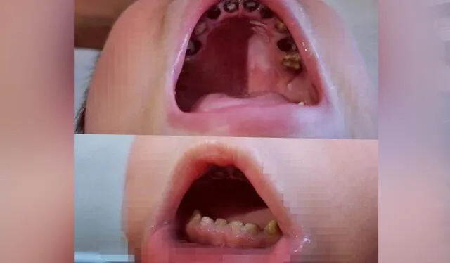 Caries | Arequipa | Hospital Honorio Delgado Caries | Arequipa | Hospital Honorio Delgado