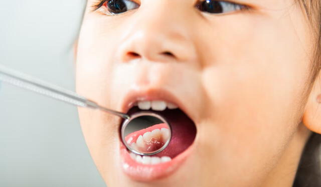 Caries | Arequipa | Hospital Honorio Delgado Caries | Arequipa | Hospital Honorio Delgado