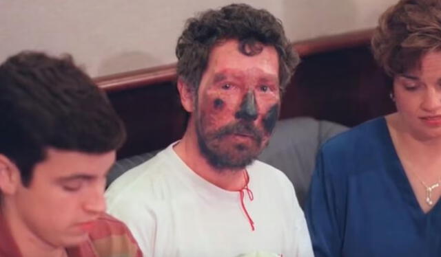 El rostro de Beck quedó negro debido al congelamiento por las altas temperaturas.   