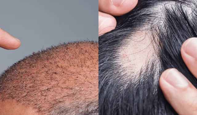 La alopecia puede generar inseguridades por la perdida de cabello en distintas zonas.<br>Fuente: Composición LR    