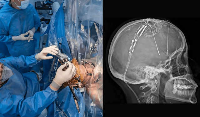 La cirugía estuvo a cargo del neurocirujano William Omar Contreras. Foto: Composición LR/ fcvcolombia<br><br> La cirugía estuvo a cargo del neurocirujano William Omar Contreras. Foto: Composición LR/ fcvcolombia<br><br>