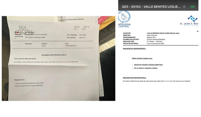  A la derecha, resultado de la primera biopsia hecha por la Liga Contra el Cáncer; a la izquierda, segunda biopsia guiada hecha en la clínica del doctor Jaime Montes. Foto: composición LR   