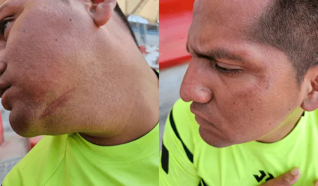 Árbitro muestra las heridas en su rostro. Créditos: Yolanda Goicochea / La República.<br><br> Árbitro muestra las heridas en su rostro. Créditos: Yolanda Goicochea / La República.<br><br>
