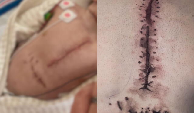  Las cicatrices del pequeño Benny Conklin y el tatuaje de su padre. Fuente: Instagram   