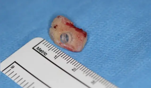  Un diente canino de Brent Chapman fue tallado e implantado en su ojo para restaurar su visión. Foto: 24horas   