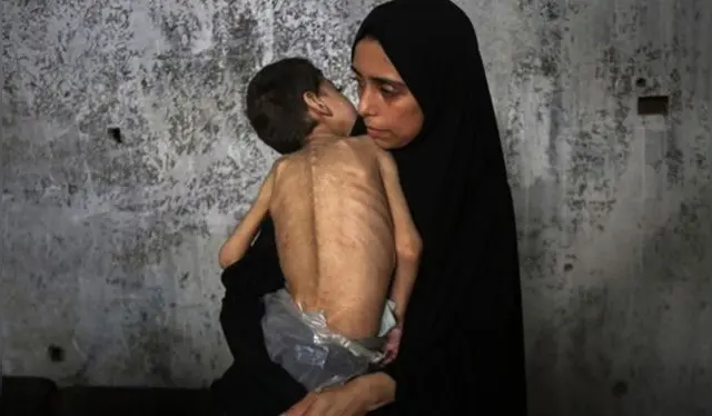 <em>Imagen del 25 de julio de 2025 de un niño palestino desplazado que sufre desnutrición y parálisis cerebral visto en el interior de una escuela transformada en refugio, en el noroeste de la Ciudad de Gaza. (Xinhua/Rizek Abdeljawad).</em> <em>Imagen del 25 de julio de 2025 de un niño palestino desplazado que sufre desnutrición y parálisis cerebral visto en el interior de una escuela transformada en refugio, en el noroeste de la Ciudad de Gaza. (Xinhua/Rizek Abdeljawad).</em>