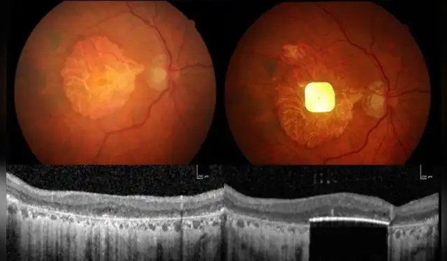 Prima es un microchip inalámbrico que se implanta en la parte posterior del ojo. Foto: EFE/ Consorcio Science Corporation   