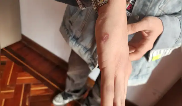 Renato Ríos perdió la movilidad de su dedo tras caerle una esquirla durante la protesta el pasado octubre. Foto: Adrián Sarria Muñoz / La República.<br><br> Renato Ríos perdió la movilidad de su dedo tras caerle una esquirla durante la protesta el pasado octubre. Foto: Adrián Sarria Muñoz / La República.<br><br>