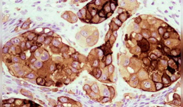 La vacuna VACCIMEL activa una fuerte respuesta inmune contra el melanoma. Foto: Conicet La vacuna VACCIMEL activa una fuerte respuesta inmune contra el melanoma. Foto: Conicet