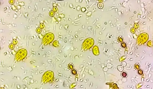 Una imagen de microscopio de G. duodenalis en una muestra. Foto: IStock Una imagen de microscopio de G. duodenalis en una muestra. Foto: IStock