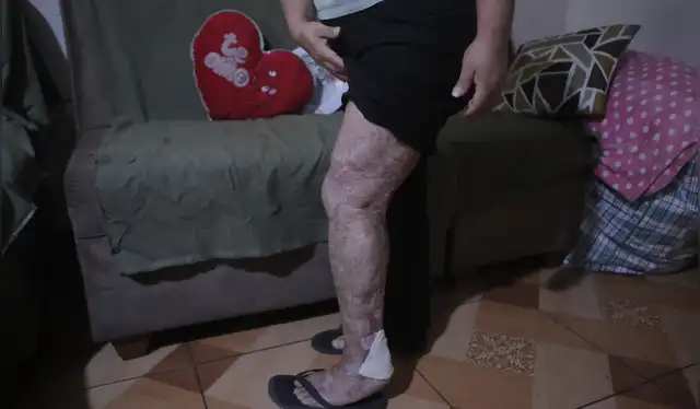  Lucero García terminó con el 70% de su cuerpo afectado. Foto: Marco Cotrina   