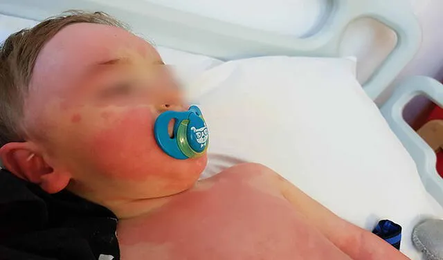Este niño fue ingresado al Hospital Worcestershire Royal (Inglaterra) cuando le brotó el sarpullido y registró una fiebre alta relacionada al MIS-C. Foto: Gemma Brown / Daily Mail