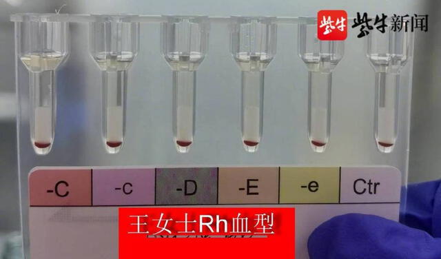 Los glóbulos rojos están recubiertos por antígenos RH, que se heredan desde el nacimiento y vienen en paquete. La ausencia del antígeno Rh-D determina si su grupo sanguíneo es positivo o negativo. Foto: Global Times / Weibo
