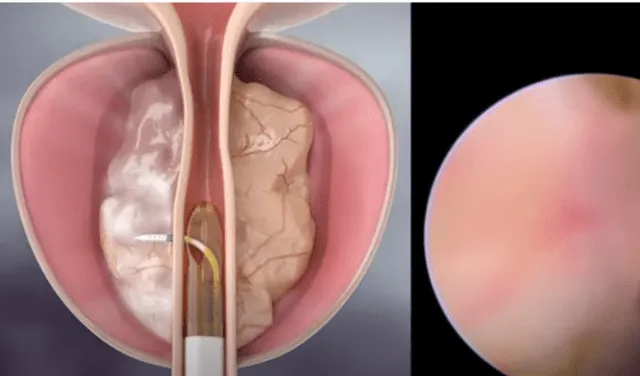 A través de las agujas se expulsa vapor de aire en la próstata agrandada, para que reduzca su tamaño. Foto: Medicina Televisión/ YouTube