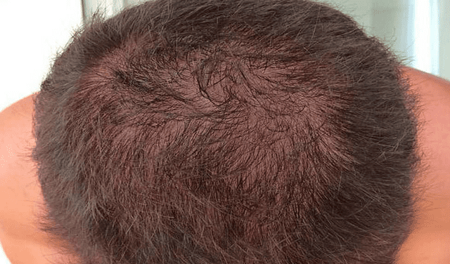 La alopecia es el término general a los diferentes problemas de caída del cabello. Foto: EFE